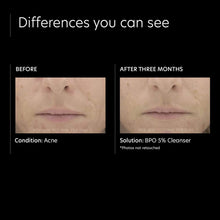 Load image into Gallery viewer, BPO 5% Cleanser